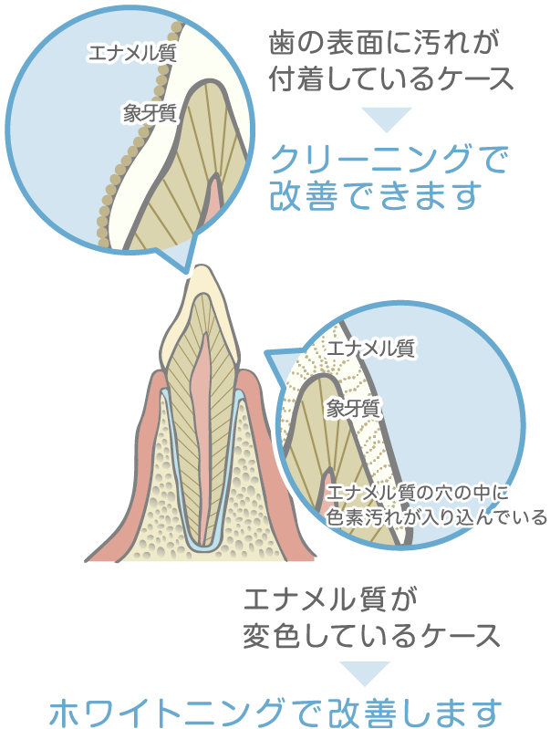 メンテナンスだけで歯を白くできる？