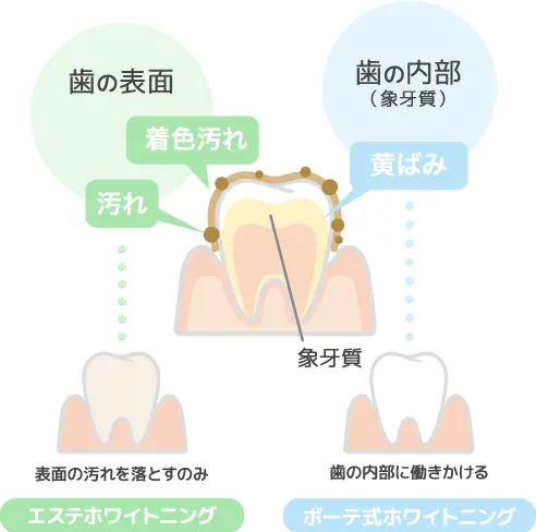 エステホワイトニングとボーテ式ホワイトニング