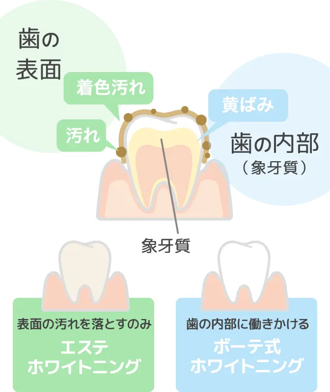 エステホワイトニングとボーテ式ホワイトニング